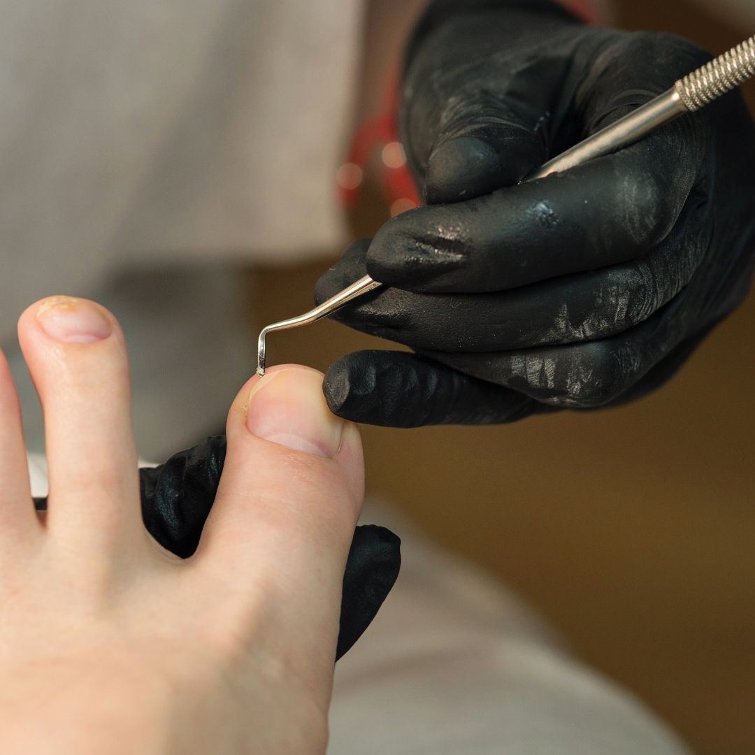 Nail Tamponade Copoline - קפולין לטמפונדה