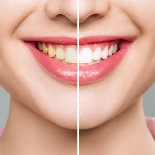 White Pro Whitening Strips - רצועות להלבנת שיניים 28 יחידות