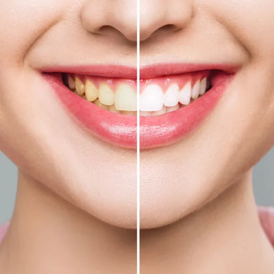 White Pro Whitening Strips - רצועות להלבנת שיניים 28 יחידות