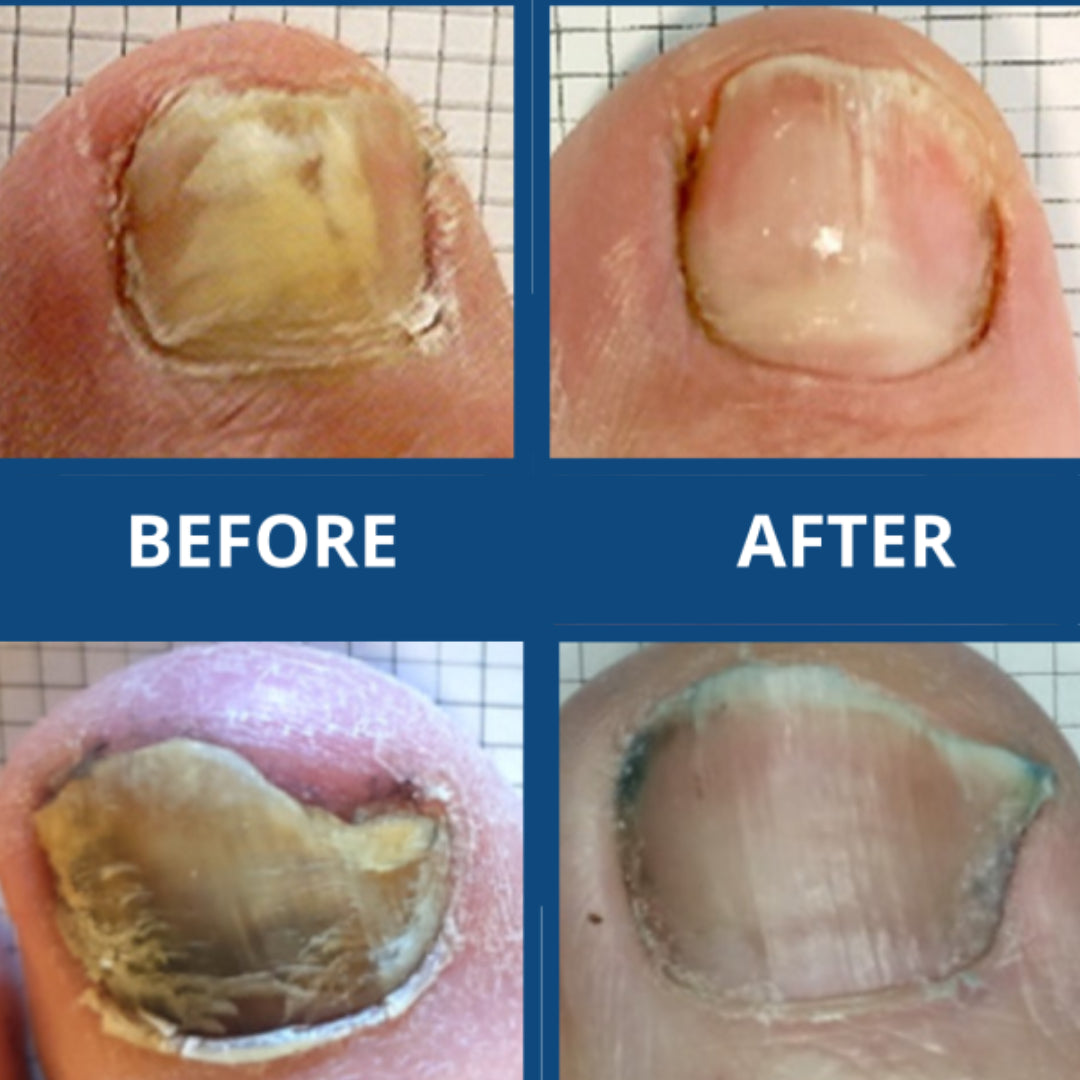 ToeFX ClearToe Therapy Light - מכשיר פוטותרפיה לפטרת ציפורניים