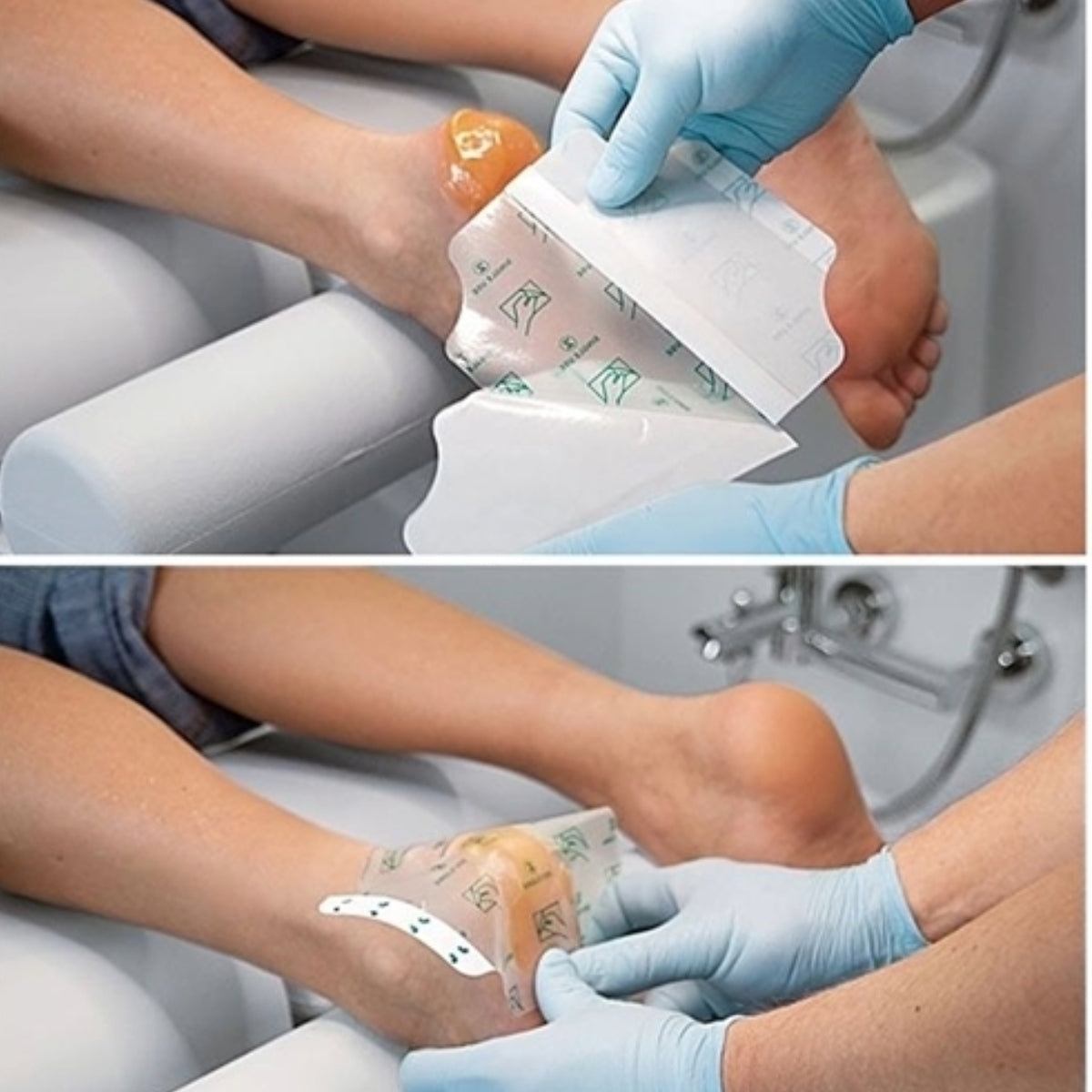 Occlusive plaster - פלסטר אוקלוסיבי