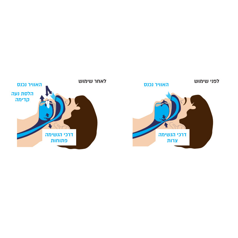 סד דנטלי נגד נחירות מותאם אישית המורכב על השיניים בזמן השינה מידה לבחירה Madosa Night Guard